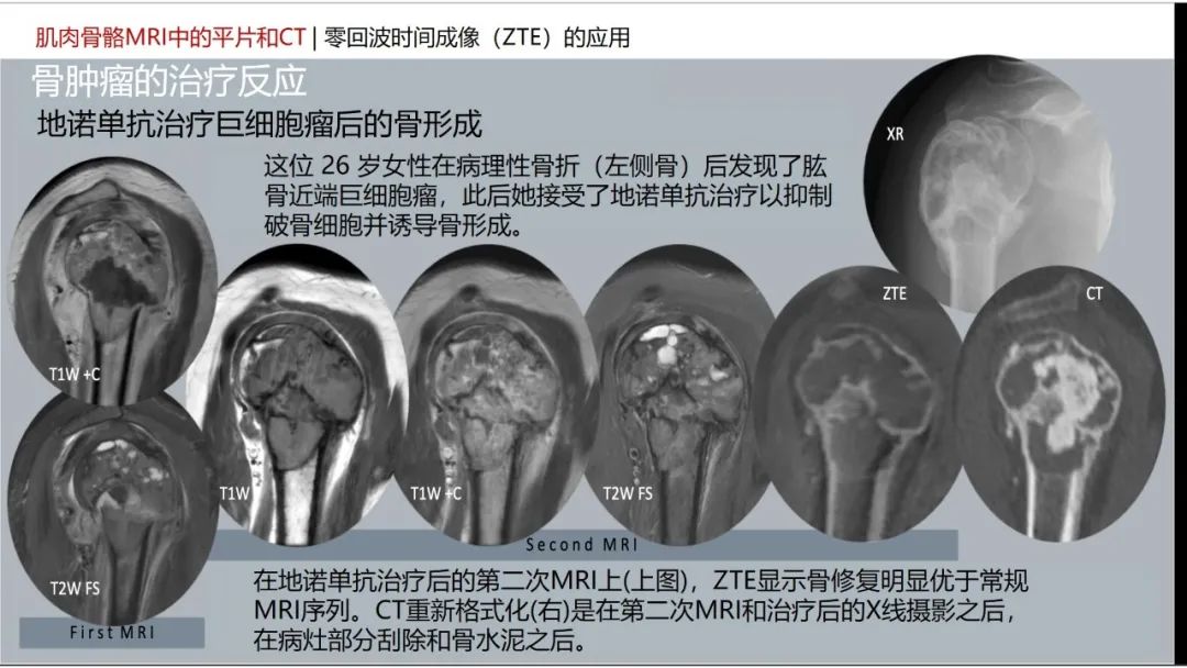 影像PPT - 【PPT】肌肉骨骼MRI中的平片和CT——零回波时间（ZTE）成像的挑战、优化和应用-39