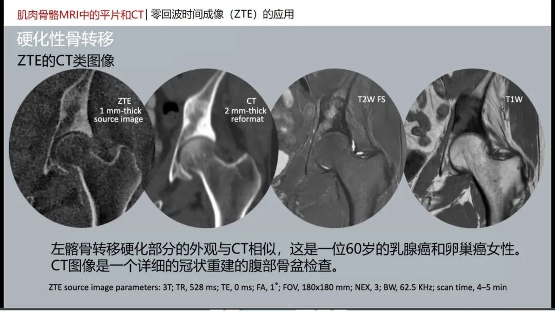 影像PPT - 【PPT】肌肉骨骼MRI中的平片和CT——零回波时间（ZTE）成像的挑战、优化和应用-41