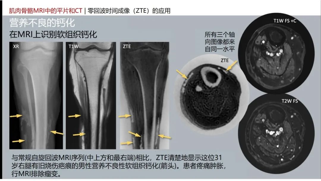 影像PPT - 【PPT】肌肉骨骼MRI中的平片和CT——零回波时间（ZTE）成像的挑战、优化和应用-43