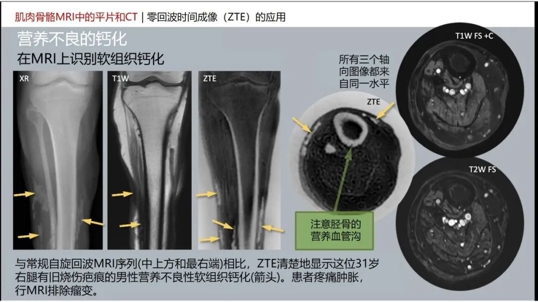 影像PPT - 【PPT】肌肉骨骼MRI中的平片和CT——零回波时间（ZTE）成像的挑战、优化和应用-45