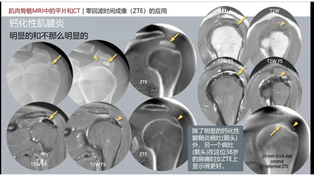 影像PPT - 【PPT】肌肉骨骼MRI中的平片和CT——零回波时间（ZTE）成像的挑战、优化和应用-47