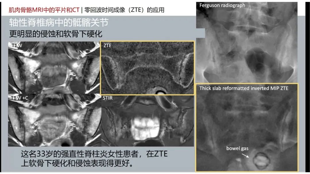 影像PPT - 【PPT】肌肉骨骼MRI中的平片和CT——零回波时间（ZTE）成像的挑战、优化和应用-49