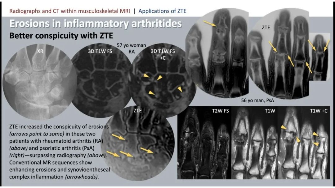 影像PPT - 【PPT】肌肉骨骼MRI中的平片和CT——零回波时间（ZTE）成像的挑战、优化和应用-52