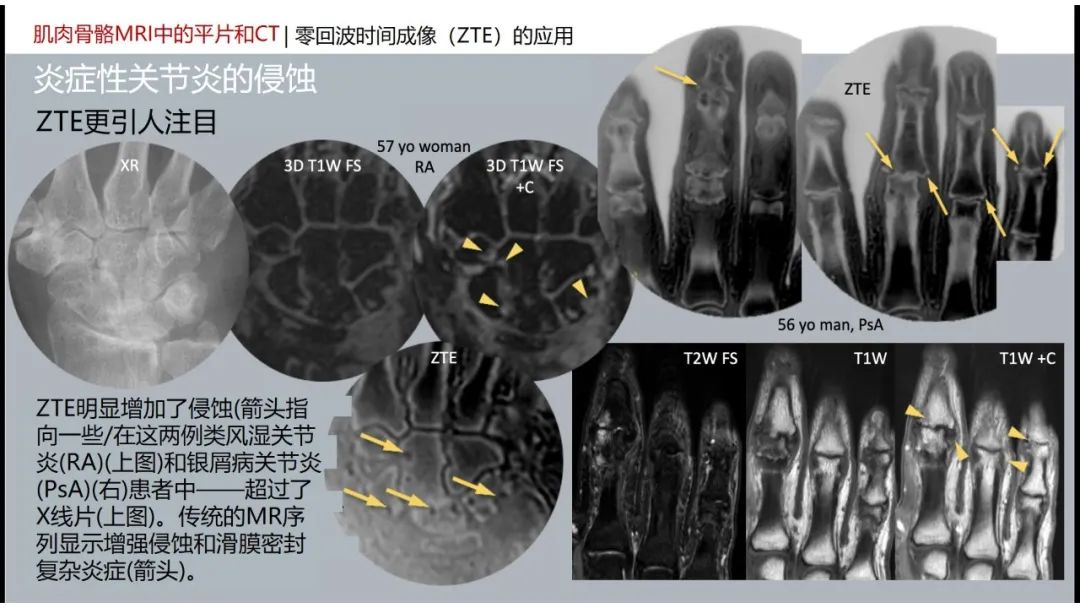 影像PPT - 【PPT】肌肉骨骼MRI中的平片和CT——零回波时间（ZTE）成像的挑战、优化和应用-51