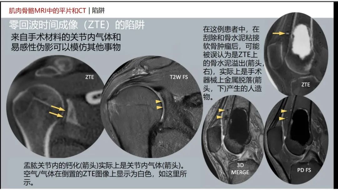 影像PPT - 【PPT】肌肉骨骼MRI中的平片和CT——零回波时间（ZTE）成像的挑战、优化和应用-53