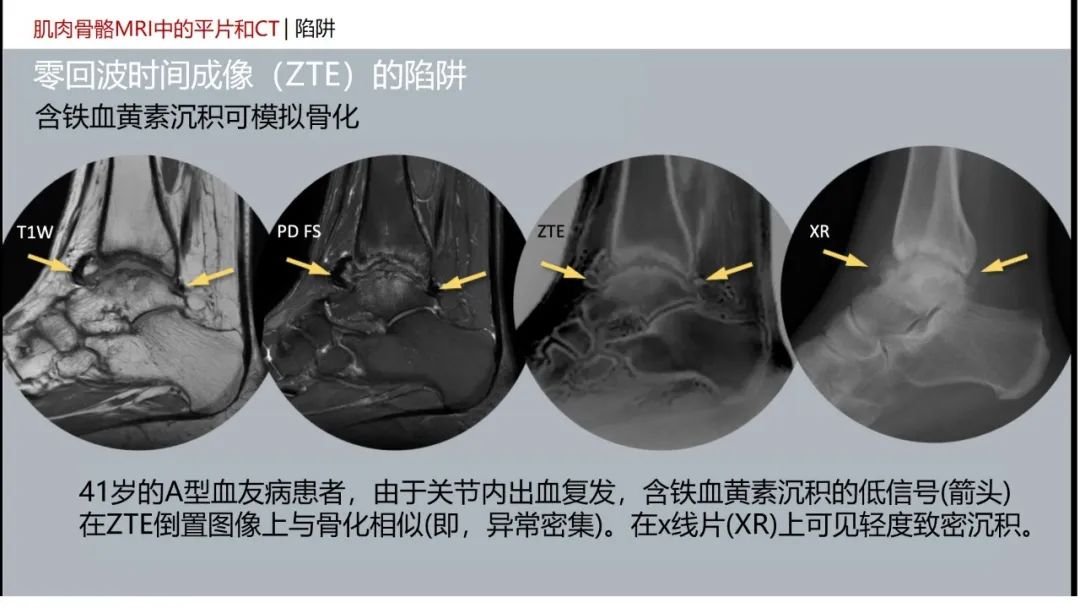 影像PPT - 【PPT】肌肉骨骼MRI中的平片和CT——零回波时间（ZTE）成像的挑战、优化和应用-55