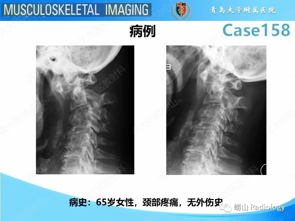 影像PPT - 【PPT】寰枢关节不稳定-2