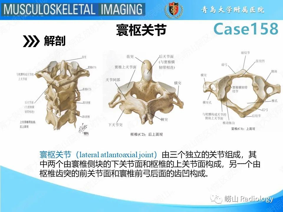 影像PPT - 【PPT】寰枢关节不稳定-11