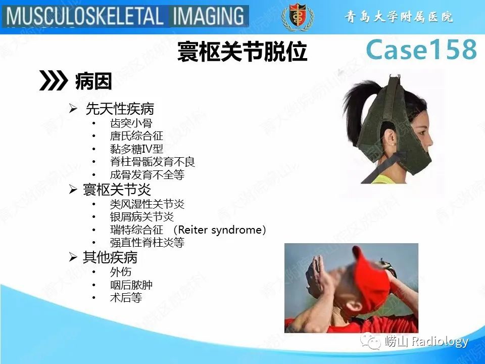 影像PPT - 【PPT】寰枢关节不稳定-15
