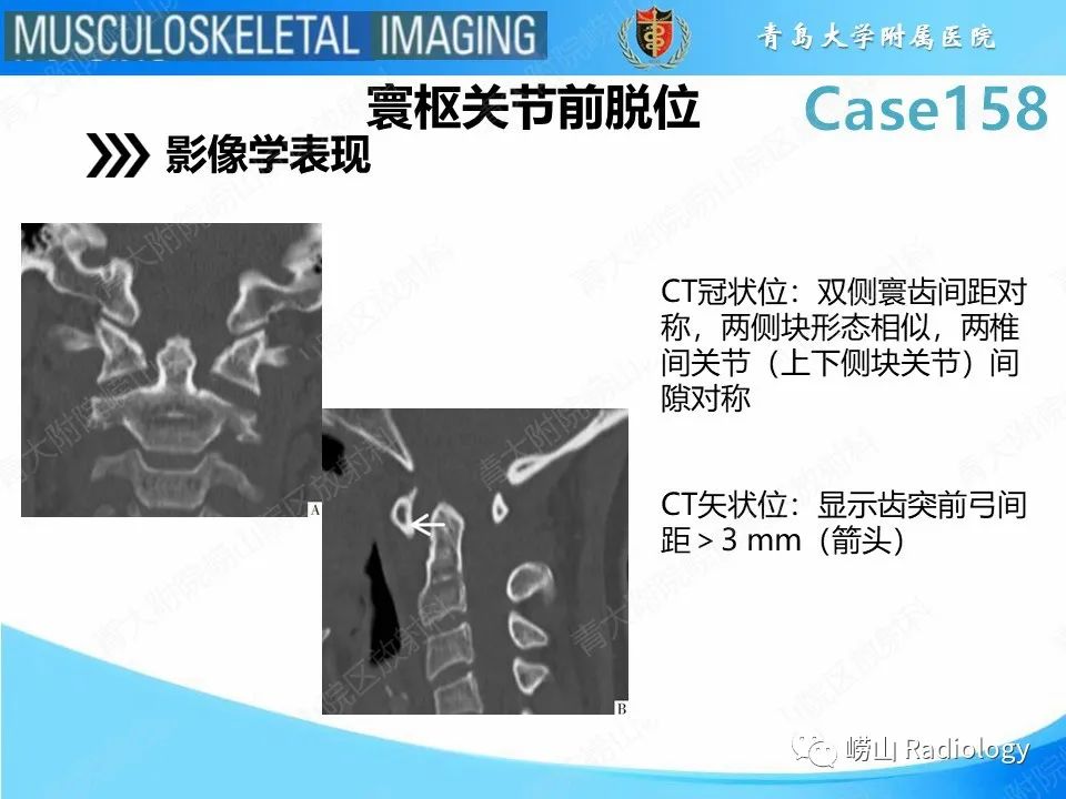 影像PPT - 【PPT】寰枢关节不稳定-17