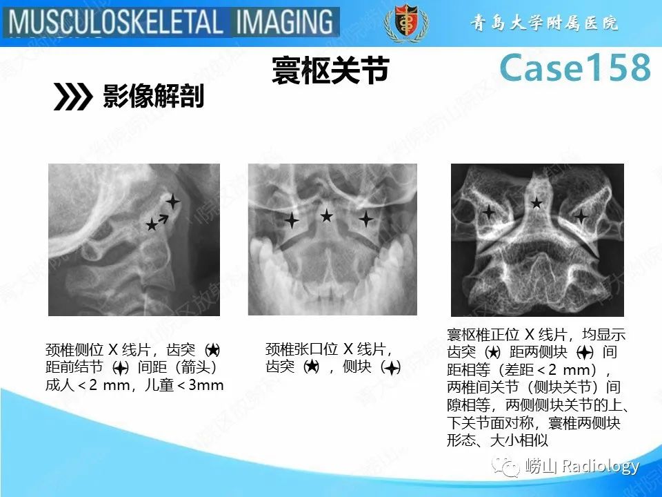 影像PPT - 【PPT】寰枢关节不稳定-14