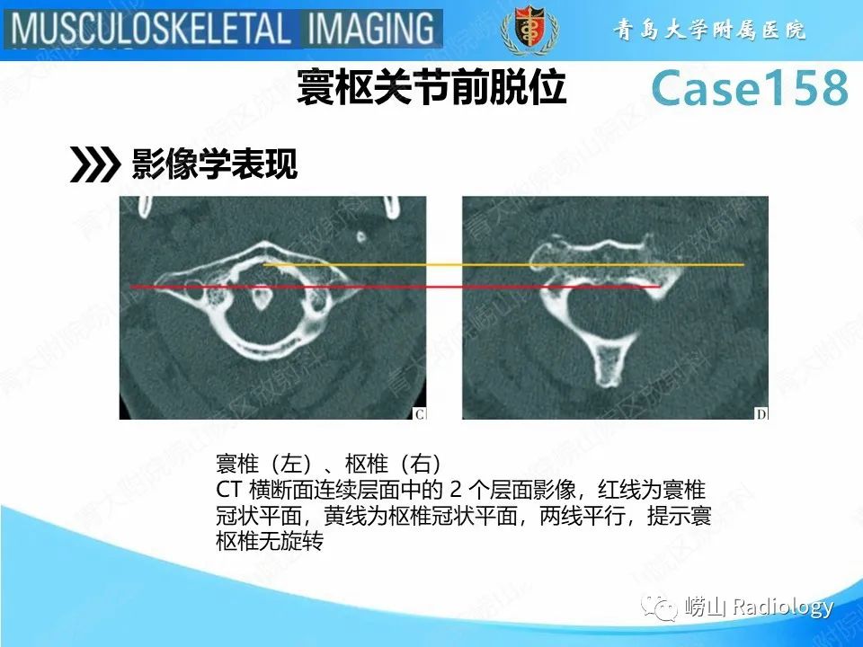 影像PPT - 【PPT】寰枢关节不稳定-18