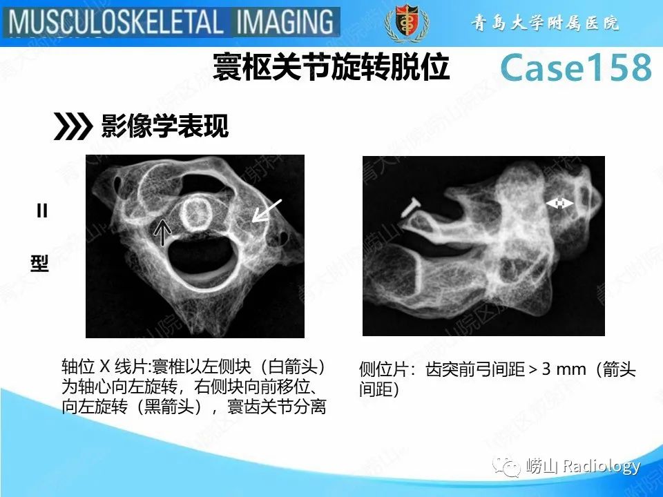 影像PPT - 【PPT】寰枢关节不稳定-21