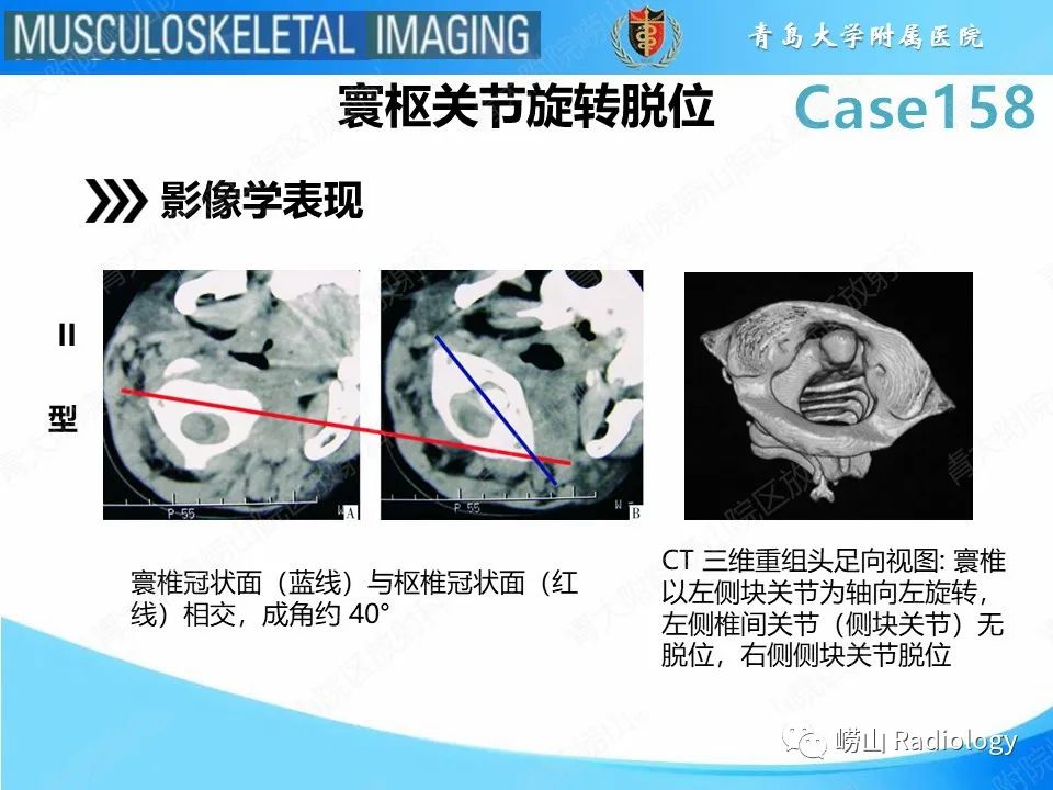 影像PPT - 【PPT】寰枢关节不稳定-22