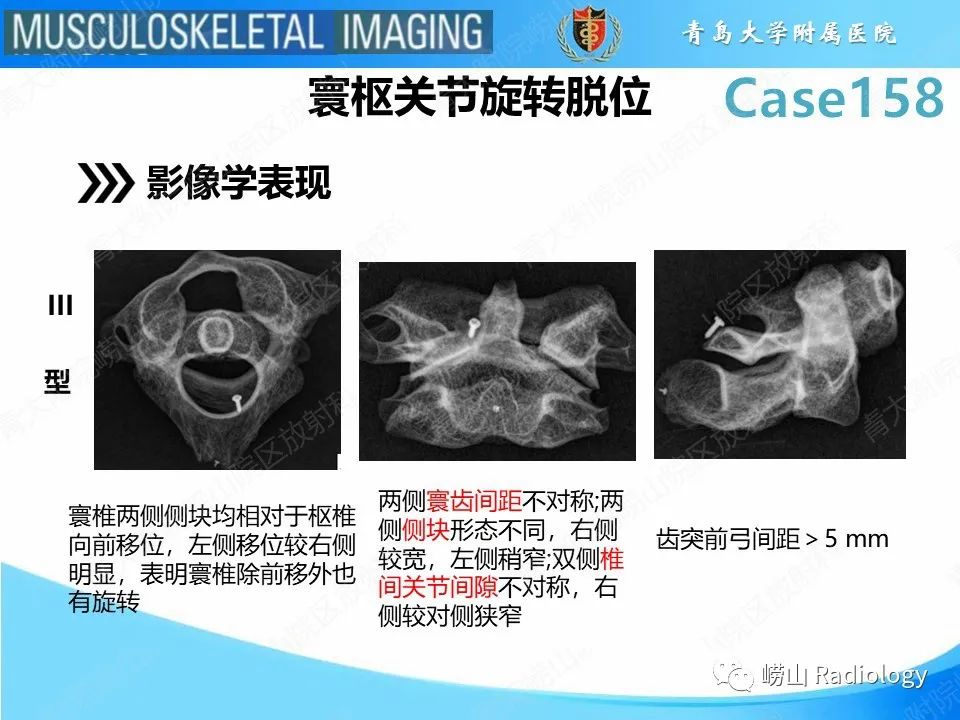 影像PPT - 【PPT】寰枢关节不稳定-23