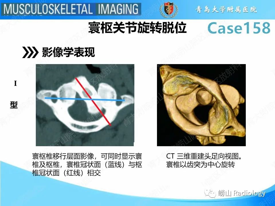 影像PPT - 【PPT】寰枢关节不稳定-20