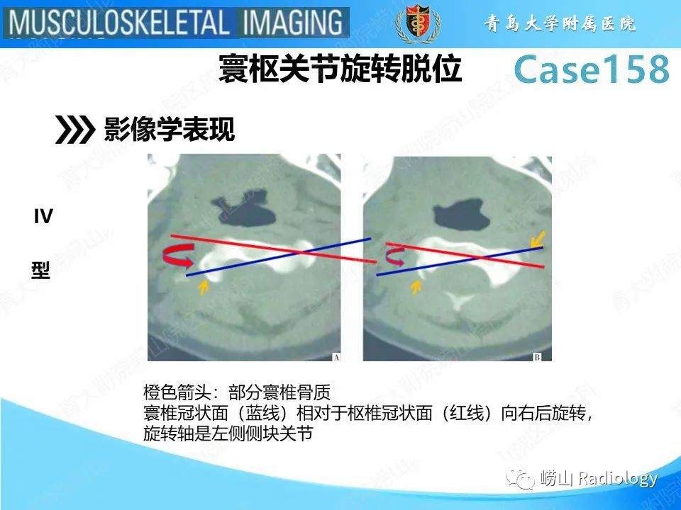 影像PPT - 【PPT】寰枢关节不稳定-24