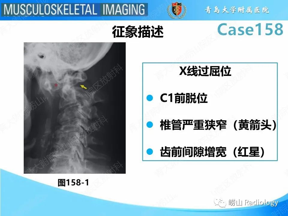 影像PPT - 【PPT】寰枢关节不稳定-25