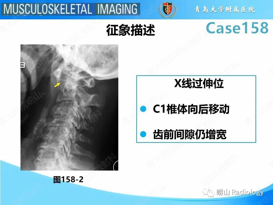 影像PPT - 【PPT】寰枢关节不稳定-26
