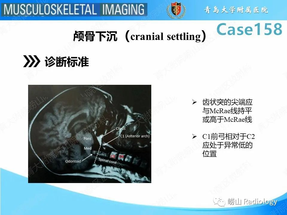 影像PPT - 【PPT】寰枢关节不稳定-29