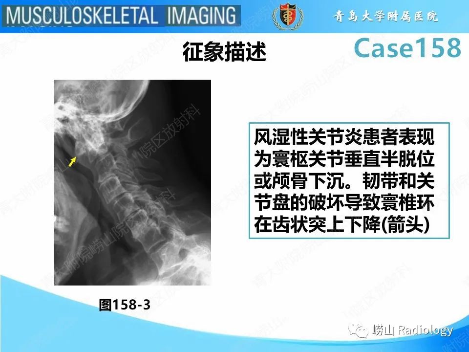 影像PPT - 【PPT】寰枢关节不稳定-30