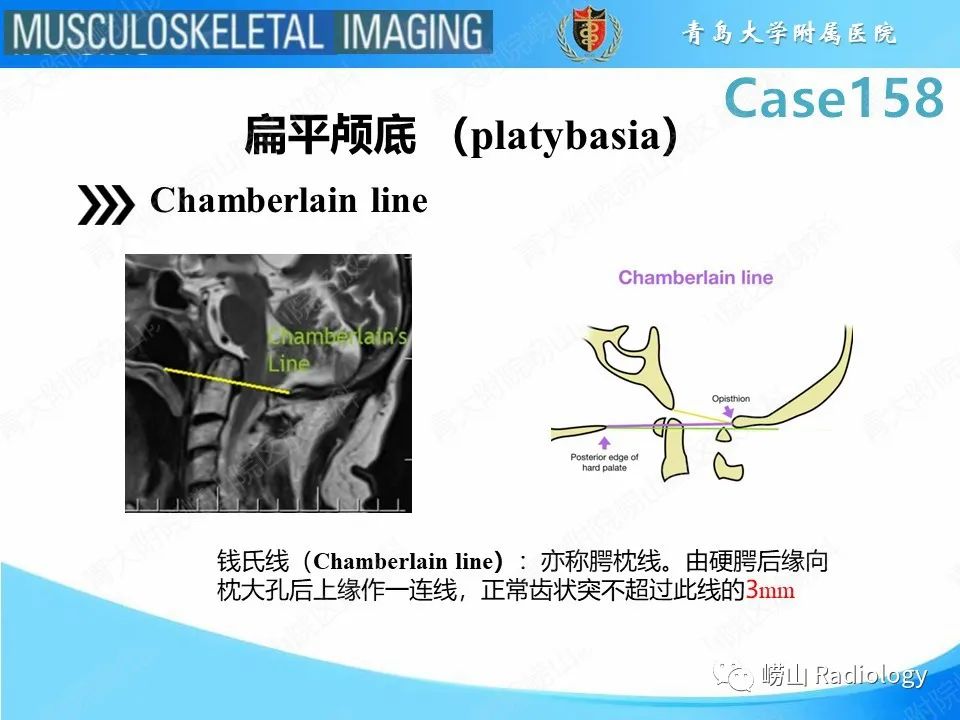 影像PPT - 【PPT】寰枢关节不稳定-33