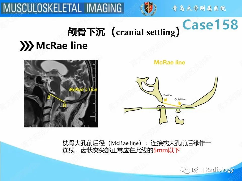 影像PPT - 【PPT】寰枢关节不稳定-28
