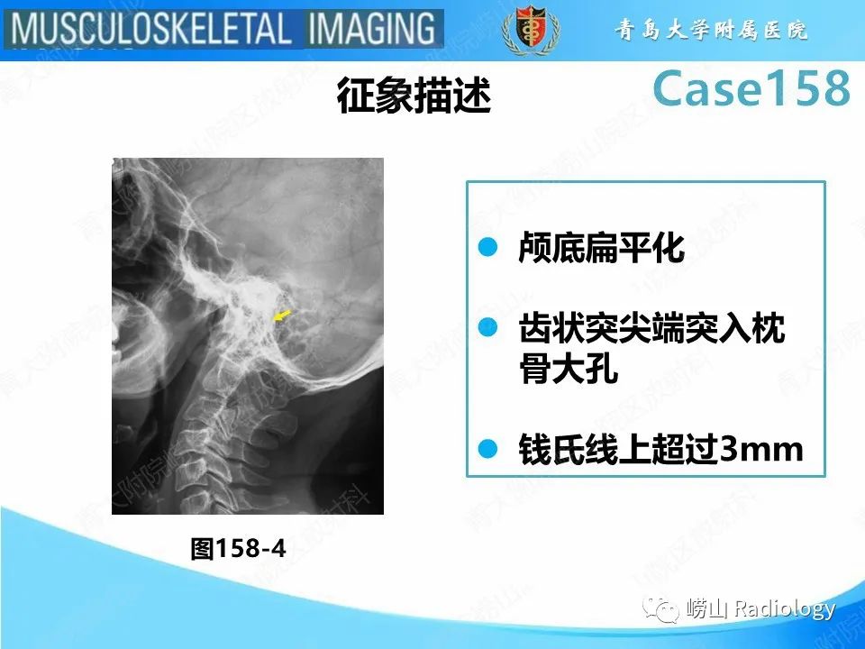 影像PPT - 【PPT】寰枢关节不稳定-34