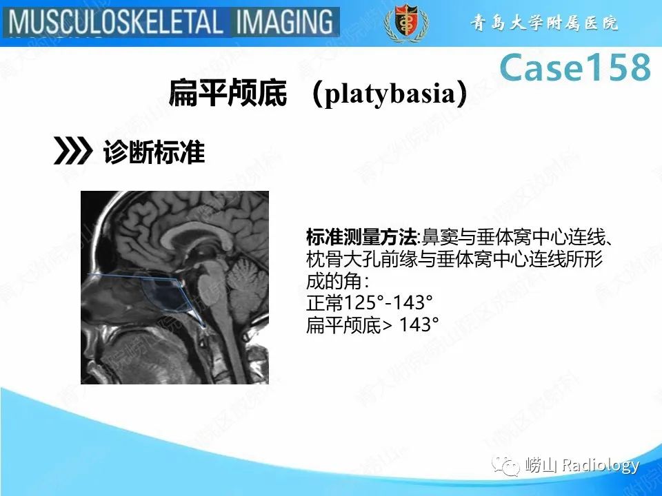 影像PPT - 【PPT】寰枢关节不稳定-32