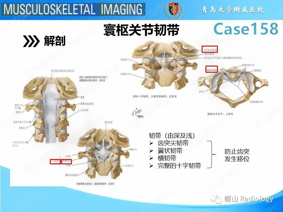 影像PPT - 【PPT】寰枢关节不稳定-2