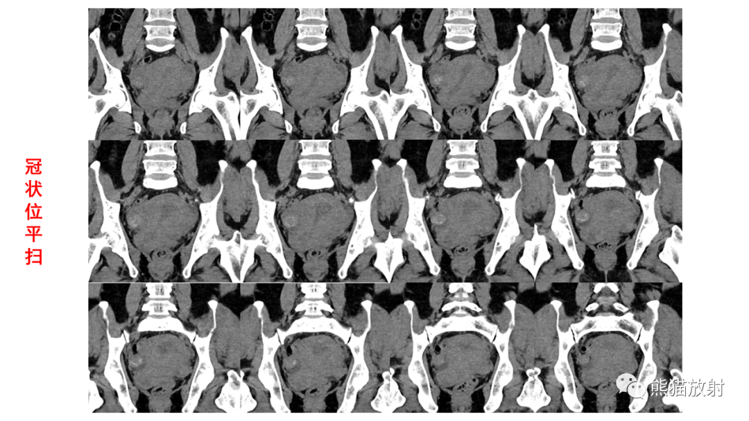 影像PPT - 【病例】卵巢Brenner瘤2例CT及MR影像-9