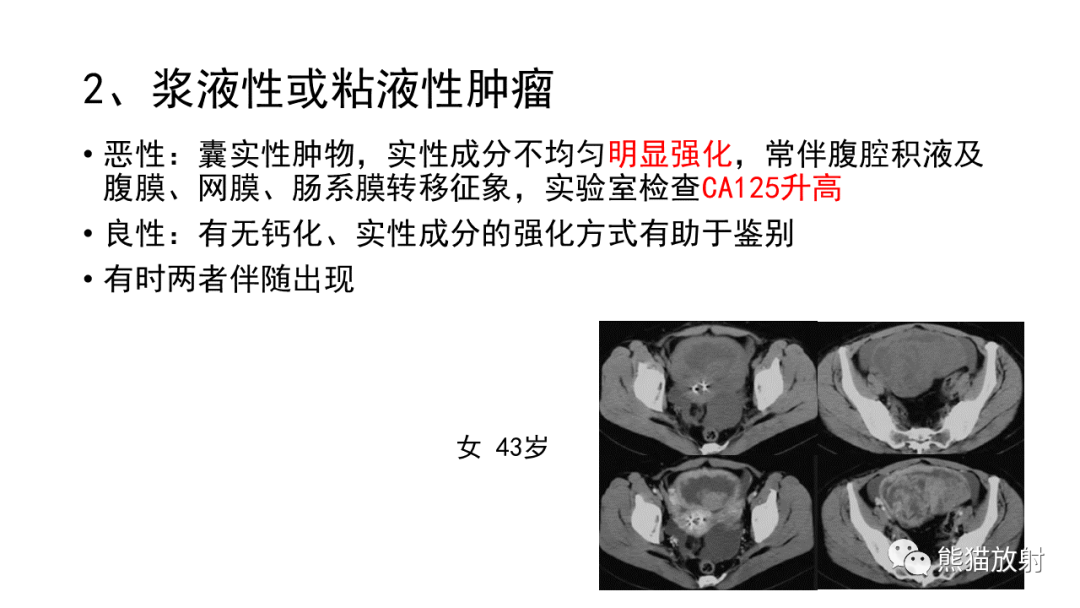 影像PPT - 【病例】卵巢Brenner瘤2例CT及MR影像-36