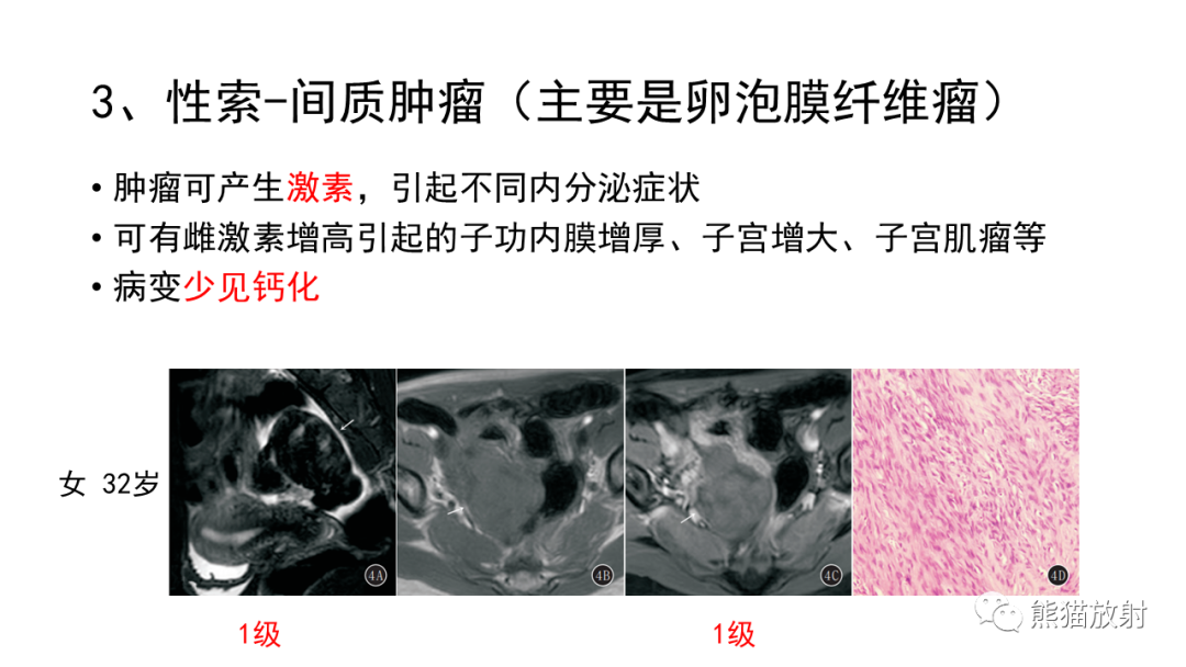 影像PPT - 【病例】卵巢Brenner瘤2例CT及MR影像-37