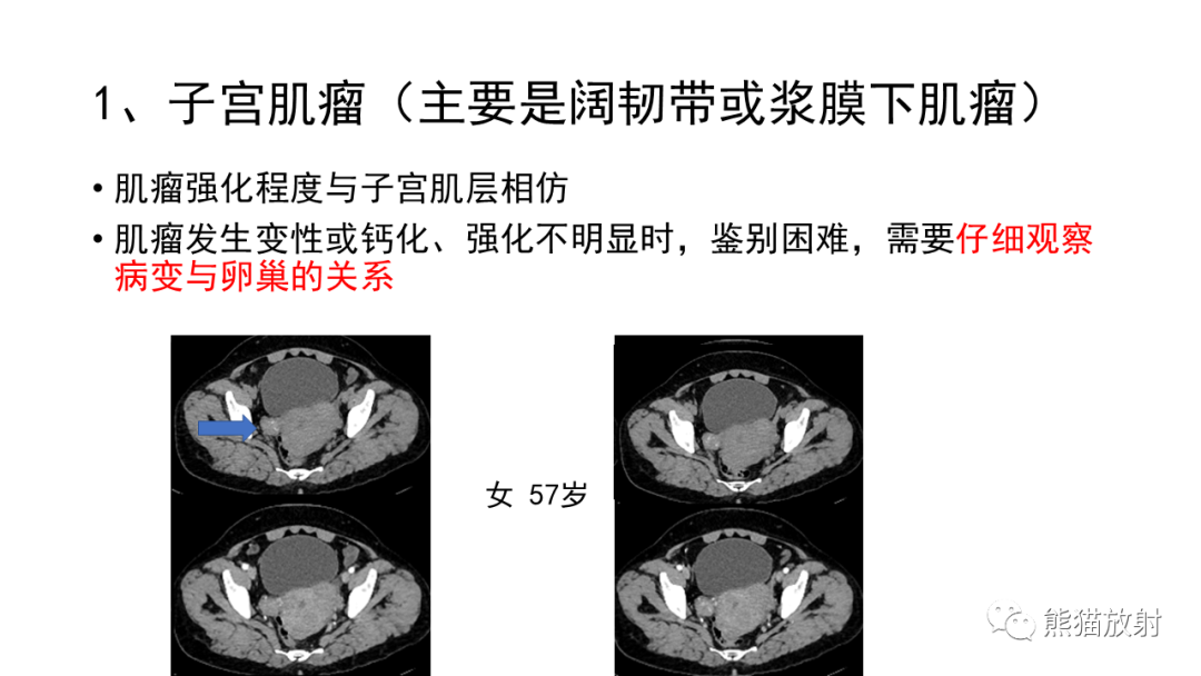 影像PPT - 【病例】卵巢Brenner瘤2例CT及MR影像-35