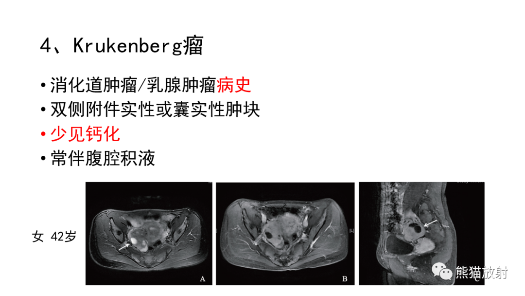 影像PPT - 【病例】卵巢Brenner瘤2例CT及MR影像-38