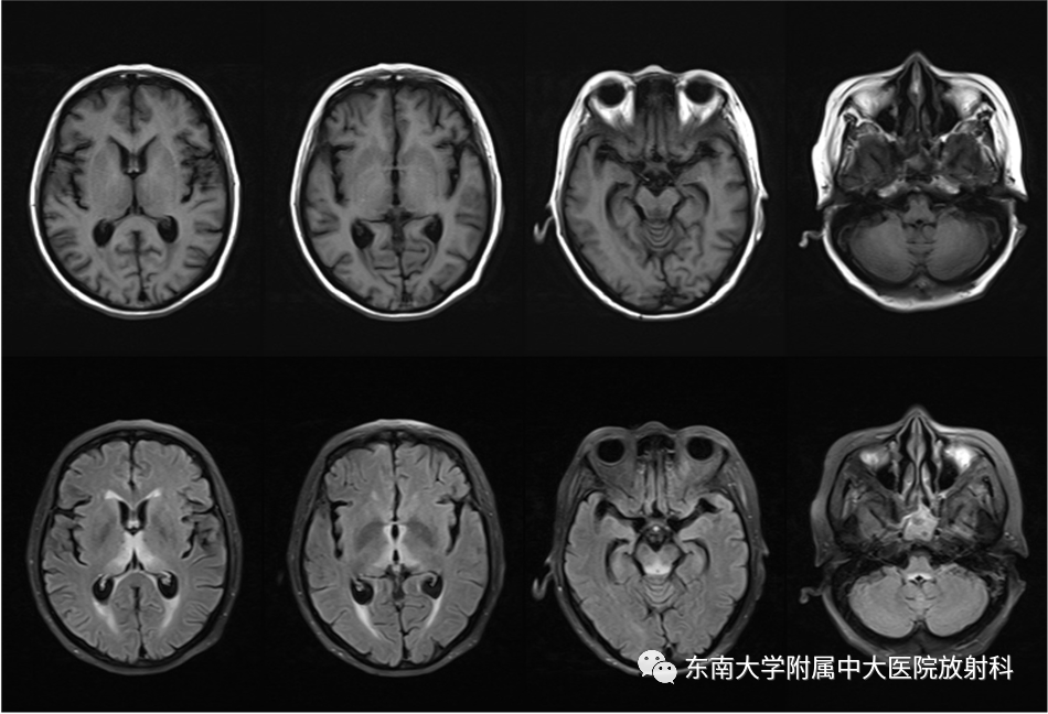 影像PPT - 【PPT】Wernicke脑病-1 影像PPT - 【PPT】Wernicke脑病-1
