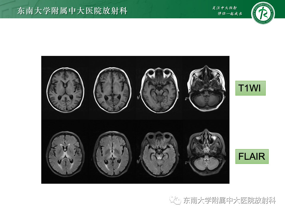 影像PPT - 【PPT】Wernicke脑病-3 影像PPT - 【PPT】Wernicke脑病-3