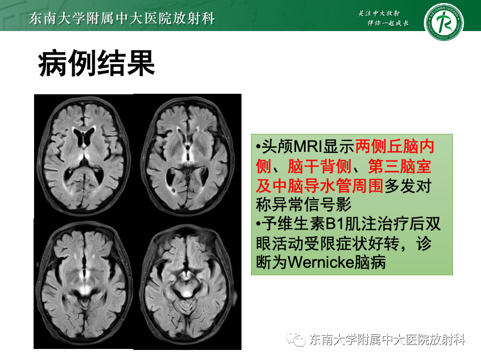 影像PPT - 【PPT】Wernicke脑病-15 影像PPT - 【PPT】Wernicke脑病-15