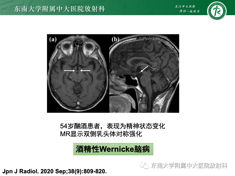 影像PPT - 【PPT】Wernicke脑病-16 影像PPT - 【PPT】Wernicke脑病-16