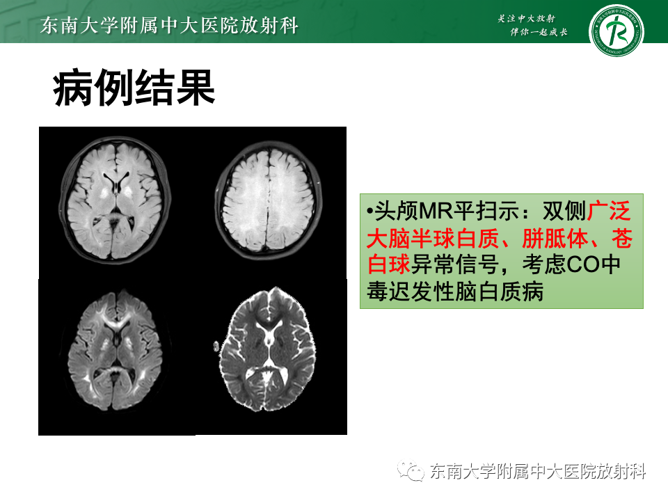 影像PPT - 【PPT】Wernicke脑病-22 影像PPT - 【PPT】Wernicke脑病-22
