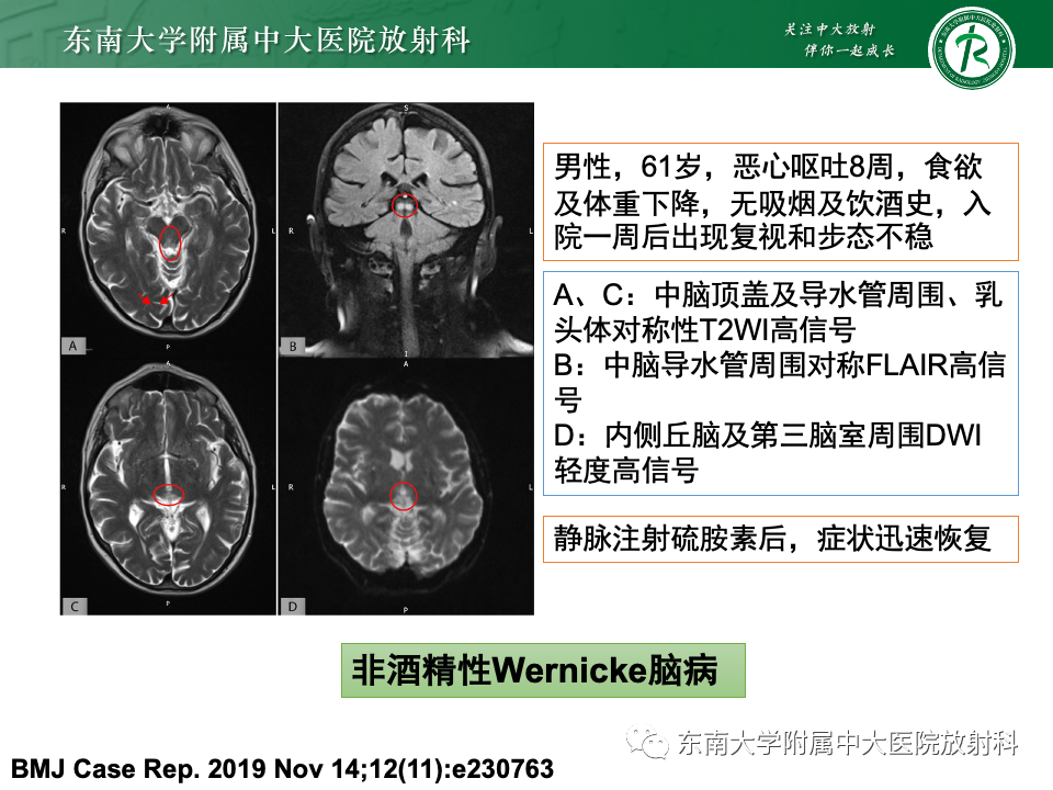 影像PPT - 【PPT】Wernicke脑病-17 影像PPT - 【PPT】Wernicke脑病-17