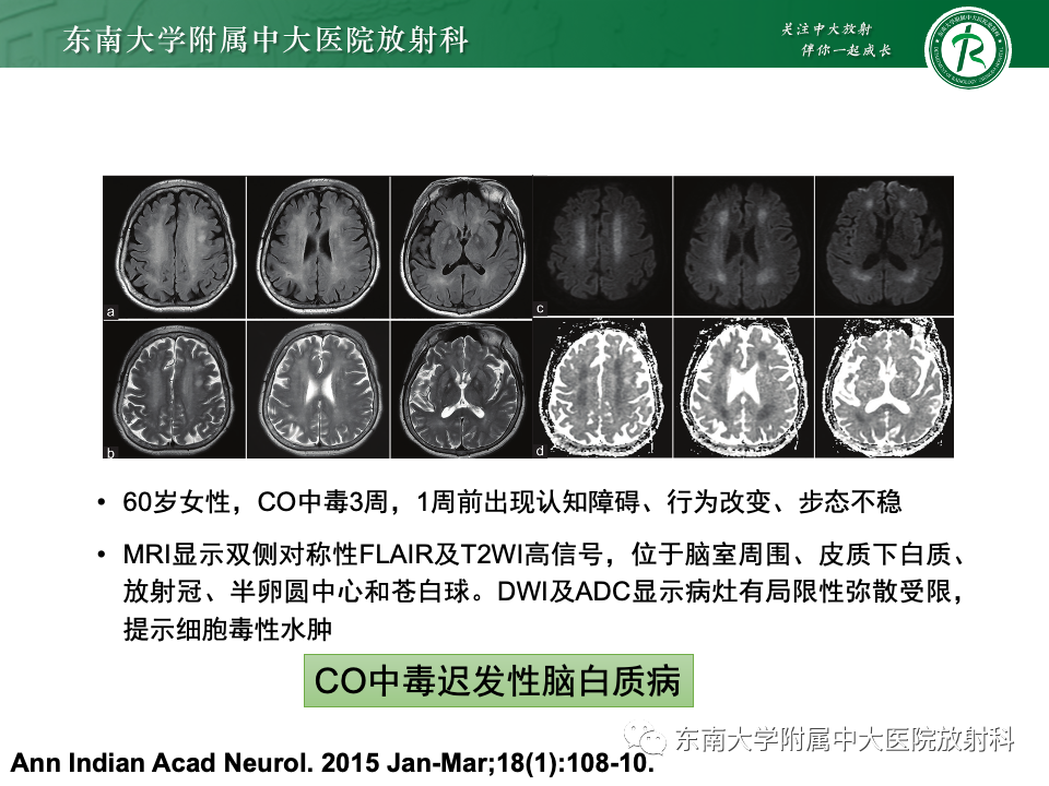 影像PPT - 【PPT】Wernicke脑病-23 影像PPT - 【PPT】Wernicke脑病-23