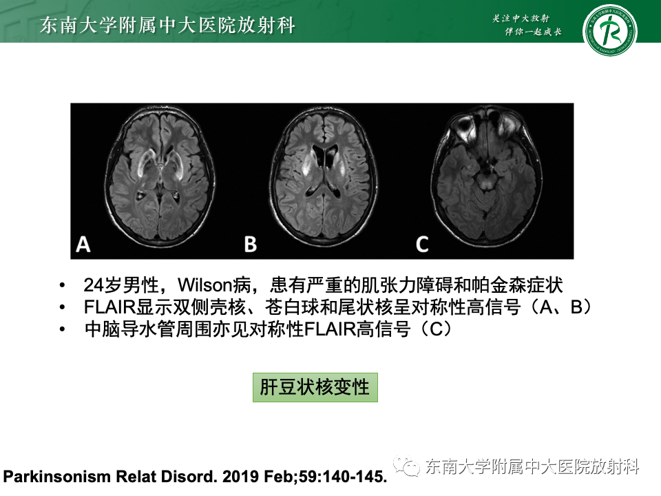 影像PPT - 【PPT】Wernicke脑病-33 影像PPT - 【PPT】Wernicke脑病-33