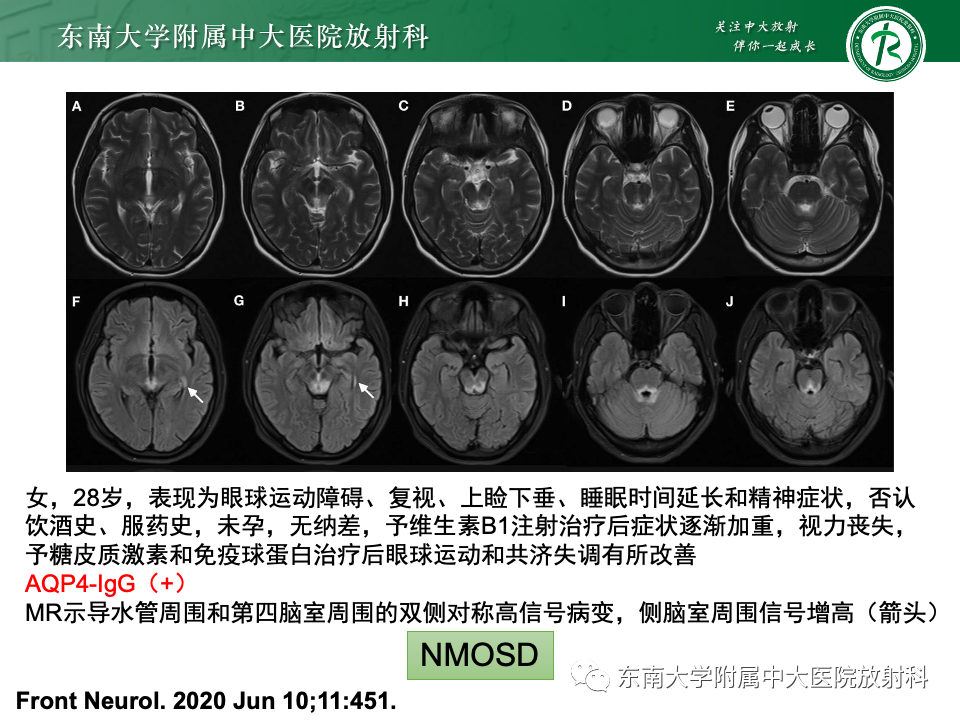 影像PPT - 【PPT】Wernicke脑病-30 影像PPT - 【PPT】Wernicke脑病-30