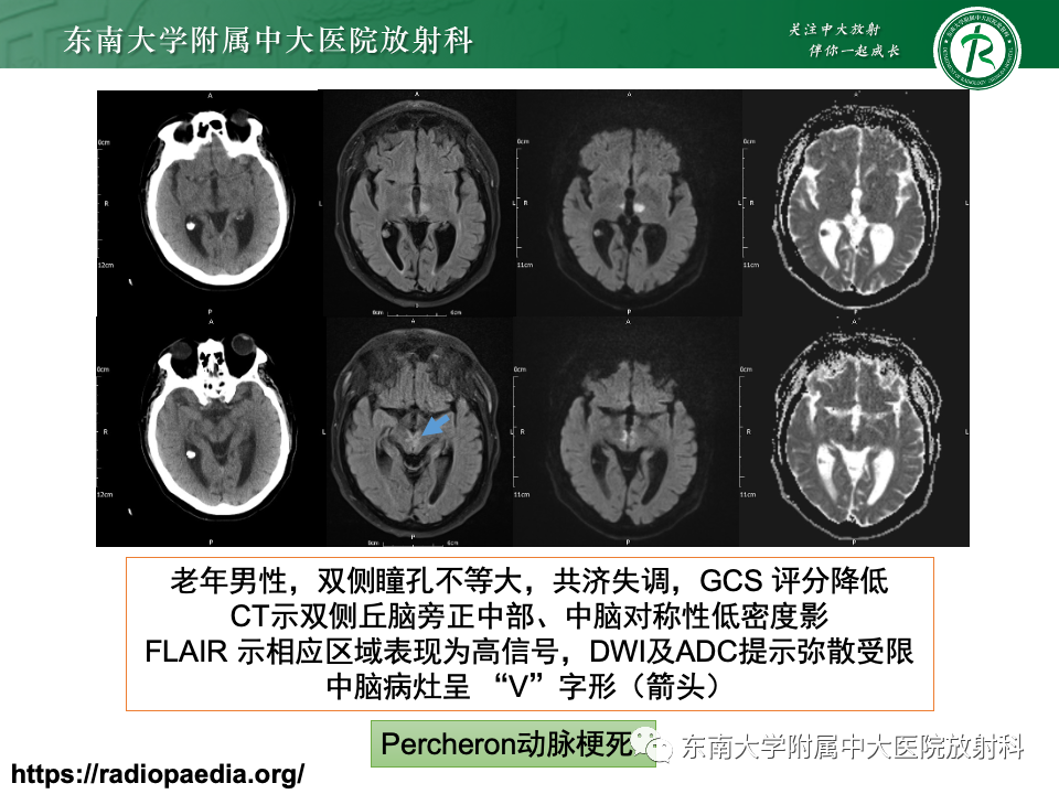 影像PPT - 【PPT】Wernicke脑病-35 影像PPT - 【PPT】Wernicke脑病-35