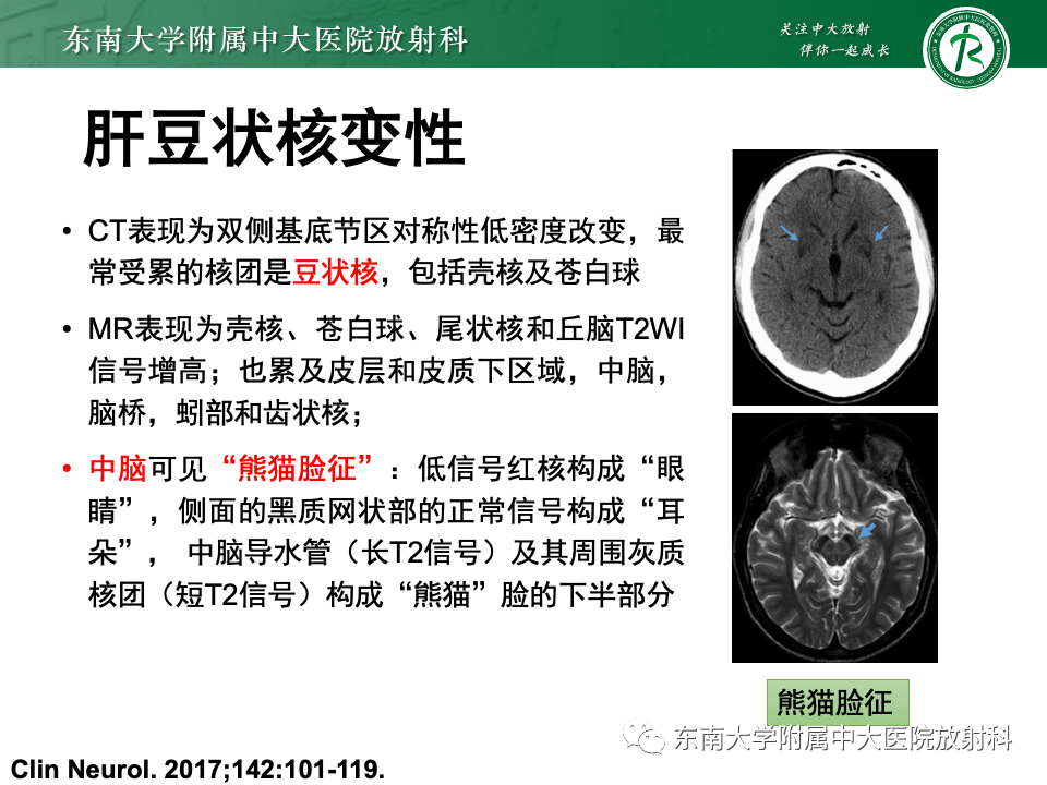 影像PPT - 【PPT】Wernicke脑病-2 影像PPT - 【PPT】Wernicke脑病-2