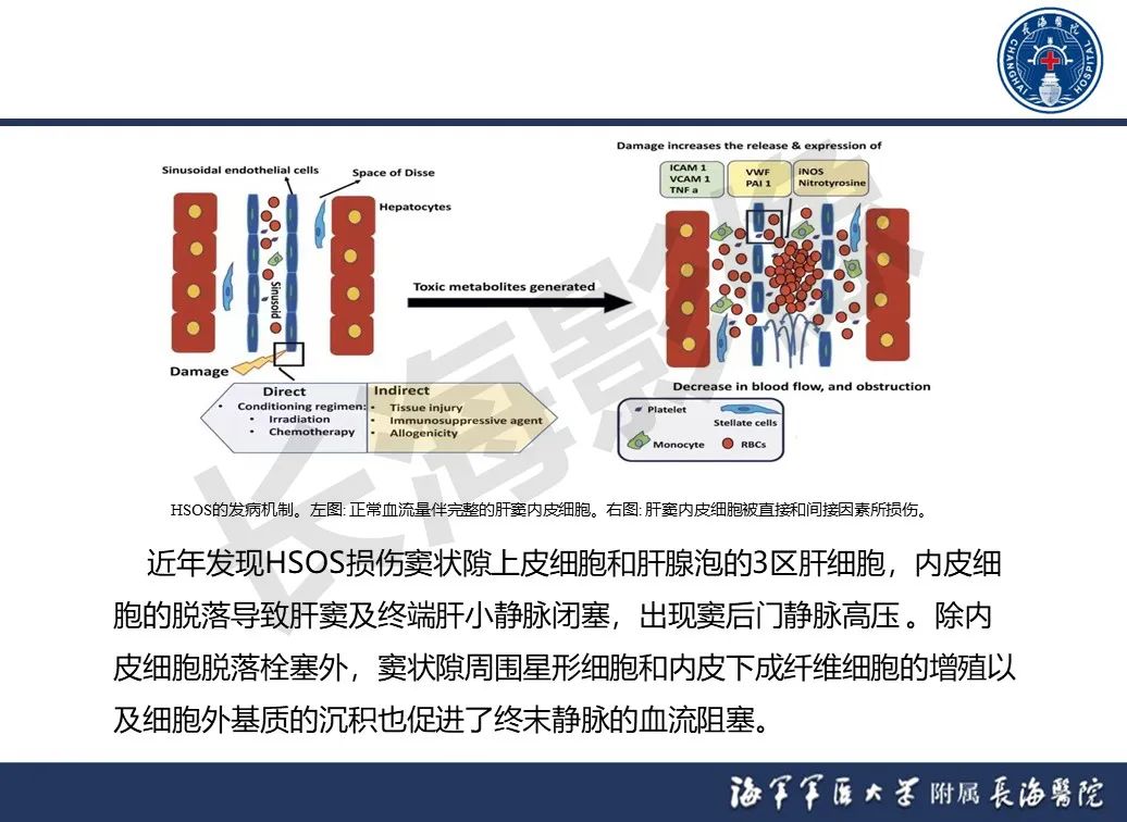 影像PPT - 【PPT】肝窦阻塞综合征的影像学诊断-11