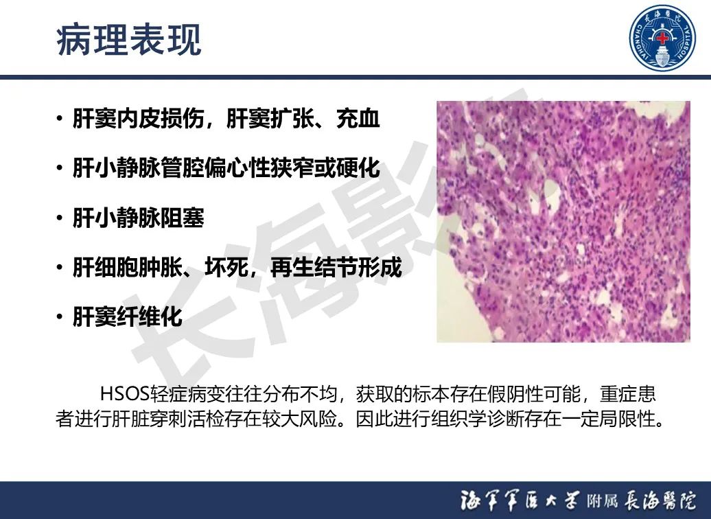 影像PPT - 【PPT】肝窦阻塞综合征的影像学诊断-12