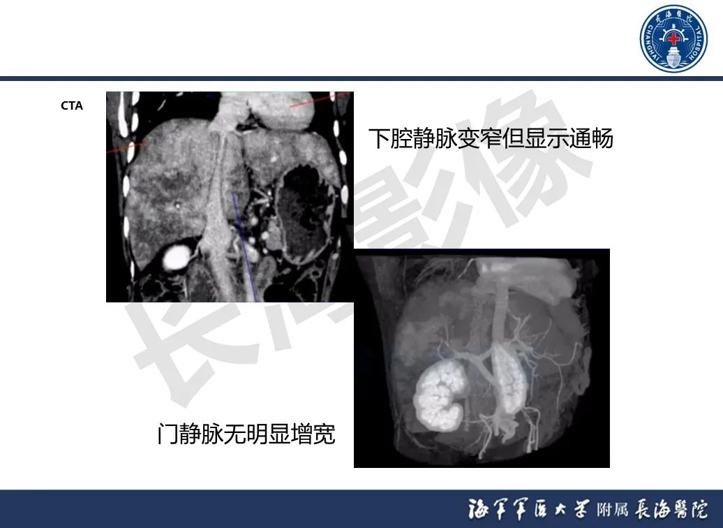 影像PPT - 【PPT】肝窦阻塞综合征的影像学诊断-33