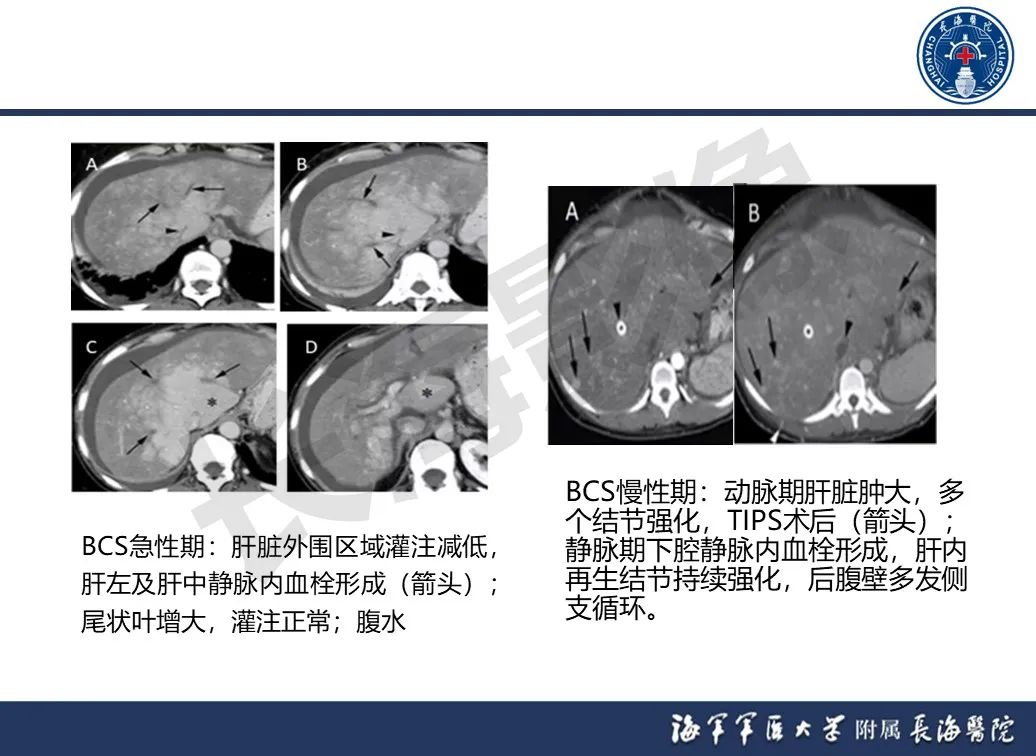 影像PPT - 【PPT】肝窦阻塞综合征的影像学诊断-45